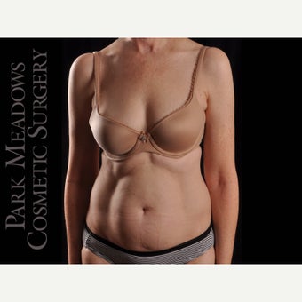 55-64 year old woman treated with Liposuction before 1747994