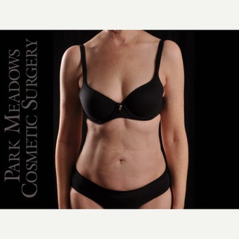 55-64 year old woman treated with Liposuction after 1747994
