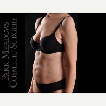 55-64 year old woman treated with Liposuction 1747994