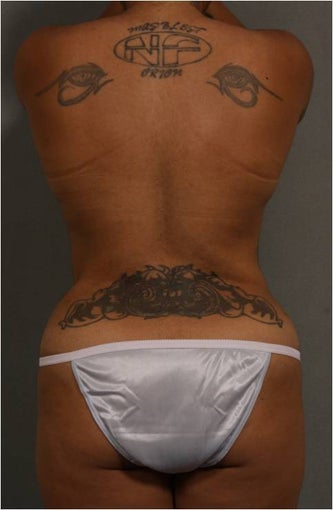 33 year old with stubborn waist fat and bra roll after 1112356