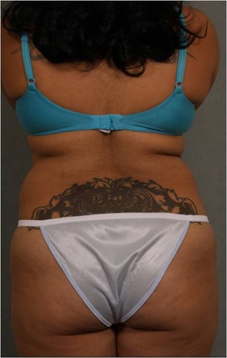 33 year old with stubborn waist fat and bra roll before 1112356