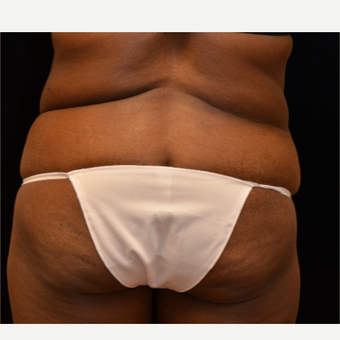 65-74 year old woman treated with Liposuction before 3575540