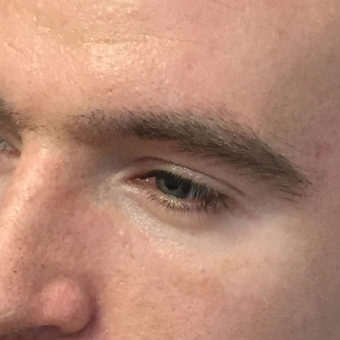 25-34 year old man treated with Eyebrow Transplant after 3411344