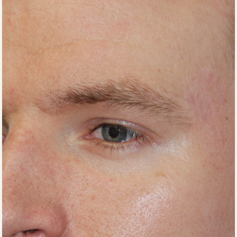 25-34 year old man treated with Eyebrow Transplant before 3411344