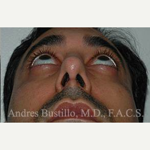 31 year old man treated with Revision Rhinoplasty after 3460742