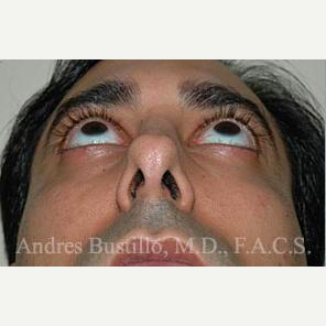 31 year old man treated with Revision Rhinoplasty before 3460742
