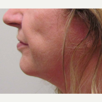 Chin Implant for this 58 Year Old Woman after 3043243