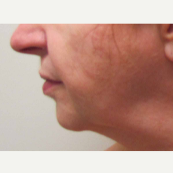 Chin Implant for this 58 Year Old Woman before 3043243