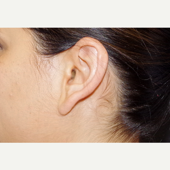 35-44 year old woman treated with Ear Lobe Surgery before 3055234