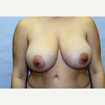 37 year old woman treated with Breast Reduction before 1671669