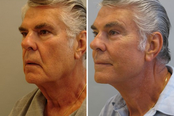 Male Facial Contouring before 1359053