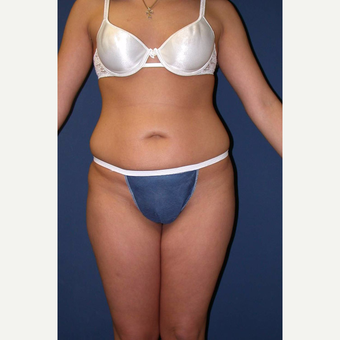 25-34 year old woman treated with SAFELipo before 3125909