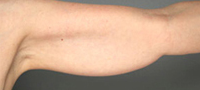 Smart Lipo: Upper Arm Area before 989027