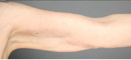 Smart Lipo: Upper Arm Area after 989027