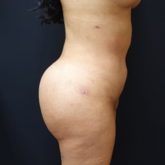 25-34 year old woman treated with Butt Augmentation after 3286193