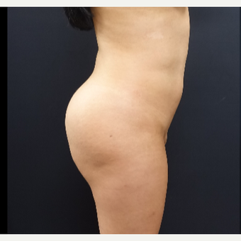 25-34 year old woman treated with Butt Augmentation before 3286193