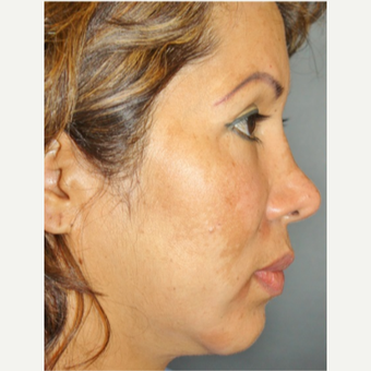 45-54 year old woman treated with Revision Rhinoplasty before 3055550