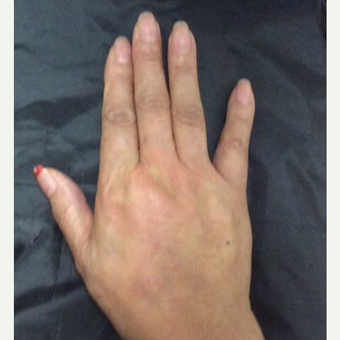 75 and up year old woman treated with Radiesse for hand rejuvenation after 3382626