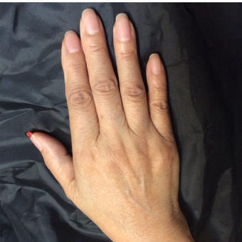 75 and up year old woman treated with Radiesse for hand rejuvenation before 3382626