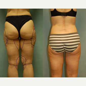 50 year old woman one year after Smartlipo of the inner and outer thighs, medial thigh and knees before 3261465