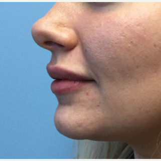 25-34 year old woman treated with Lip Augmentation after 3679411