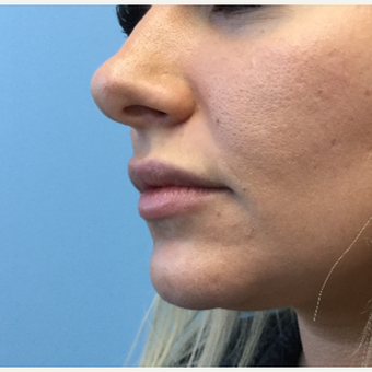 25-34 year old woman treated with Lip Augmentation before 3679411