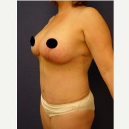 45-54 year old woman treated with Mini Tummy Tuck after 2073980