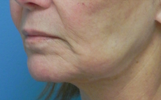 Treated with Juvederm to the upper and lower lips. before 1709054