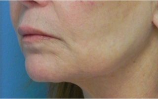 Treated with Juvederm to the upper and lower lips. after 1709054