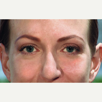 25-34 year old woman treated with Eyelid Surgery and Laser Skin Resurfacing after 3456370