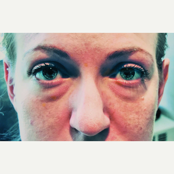 25-34 year old woman treated with Eyelid Surgery and Laser Skin Resurfacing before 3456370