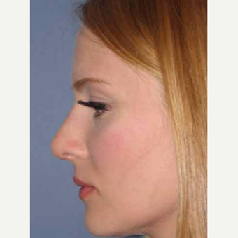 25-34 year old woman treated with Rhinoplasty after 3499708