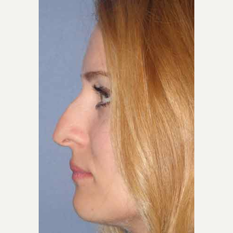 25-34 year old woman treated with Rhinoplasty before 3499708