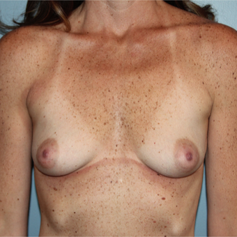 330cc Inspira Breast Implants before 3544392