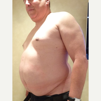 55-64 year old man treated with Tummy Tuck before 3749274