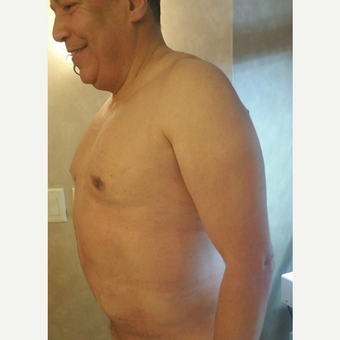 55-64 year old man treated with Tummy Tuck after 3749274