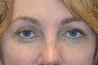 Browlift w hairline lowering, Upper eye blepharoplasty, Lower eyelid skin pinch, Fat transfer after 806961