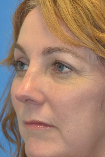 Browlift W Hairline Lowering, Upper Eye Blepharoplasty, Lower Eyelid 