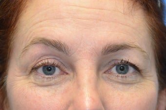 Browlift w hairline lowering, Upper eye blepharoplasty, Lower eyelid skin pinch, Fat transfer before 806961
