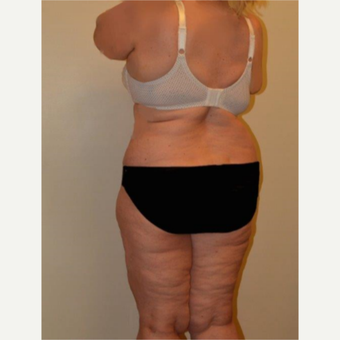 45-54 year old woman treated with Liposuction before 3658221