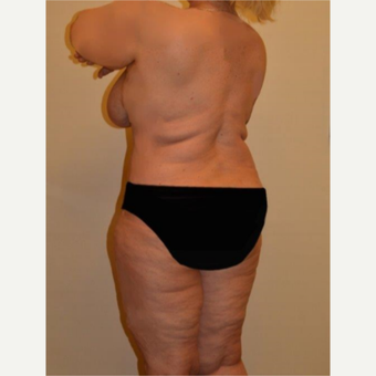 45-54 year old woman treated with Liposuction after 3658221