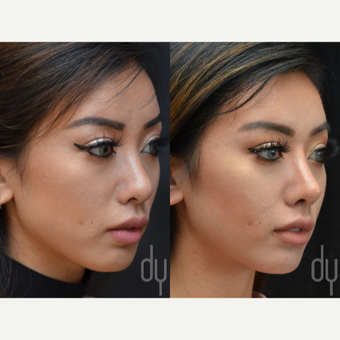 Asian Rhinoplasty with Rib cartilage before 3739404
