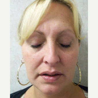 35-44 year old woman treated with Rhinoplasty before 3691950