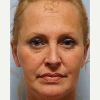 35-44 year old woman treated with Rhinoplasty after 3691950