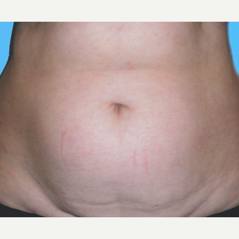 Liposuction before 3810450