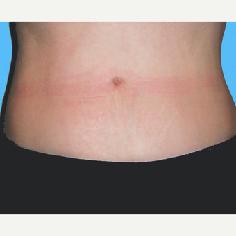 Liposuction after 3810450