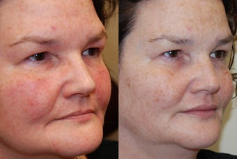 Silikon-1000 for Lip Augmentation and Marionette Grooves. before 1036188