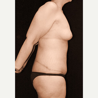 Body Contouring after Sleeve Gastrectomy after 3332777