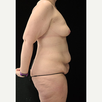 Body Contouring after Sleeve Gastrectomy before 3332777