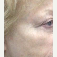 65-74 year old woman treated with Pelleve 1599204